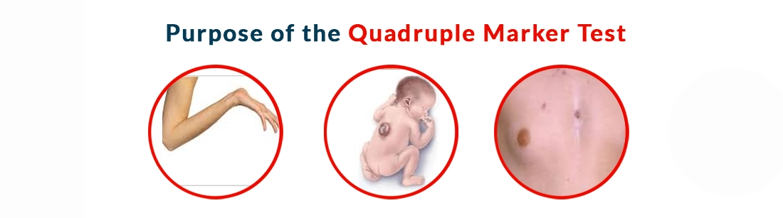 Purpose of the Quadruple Marker Test